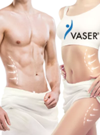 威塑抽脂 Vaser