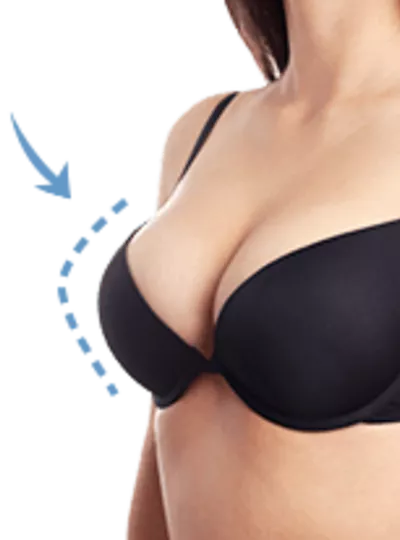 自體脂肪隆乳